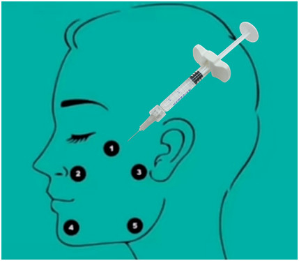 非32mg H-HA L-HAの十字によってつながれるHyaluronic酸の注入口のHyaluronic酸のゲル