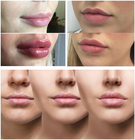 Hyaluronic酸の注射可能な注入口1ml 2ml 5mlが付いている滑らかなライン/ふくよかな唇