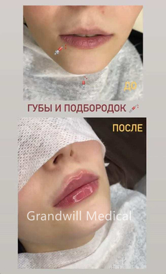 24mg/ml 皮膚にヒアルロン酸を注入し,しわを滑らかにする