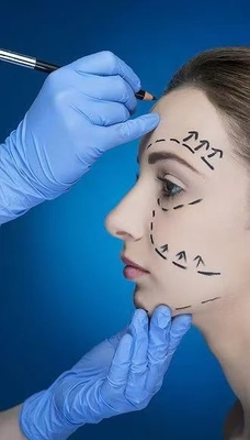 滑らかなくねみと 細かい口腔線 顔の皮膚フィルラーで 70% HA クロスリンク 24mg 30% カルシウムヒドロキシラパチート