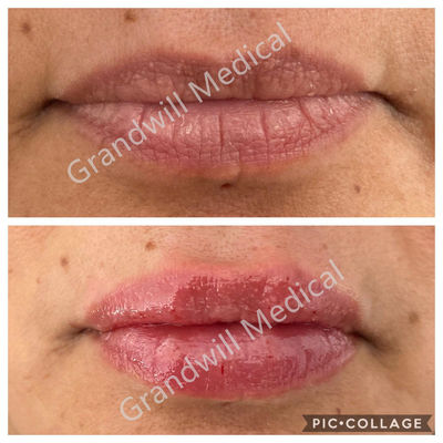 唇Augmentation Injectable Hyaluronic Acid Gel Dermal Filler 1ml 2ml