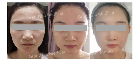 Hyaluronic酸PCLの皮のブスターの奇跡は皮のコラーゲンの刺激物に触れる