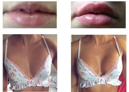 胸の拡大の注入の注入口のHyaluronic酸のインプラント唇の注入の皮膚注入口