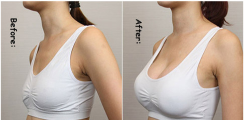 唇 顔 むくみ 乳房 増殖 股関節 補給剤 インジェクション